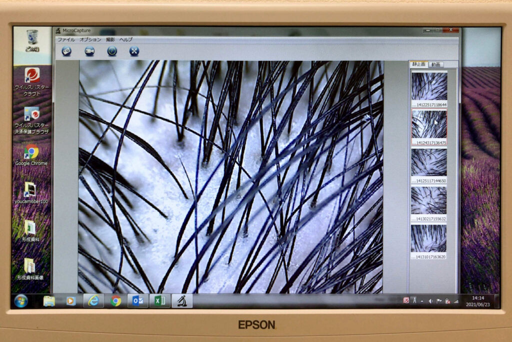 Enlarged image of the man's scalp on the Epson display
