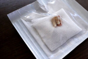 pulled out transplantation tooth